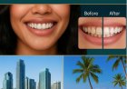 From Consultation to Perfection: Veneers by One Global Dental Specialist and Sands & Smiles